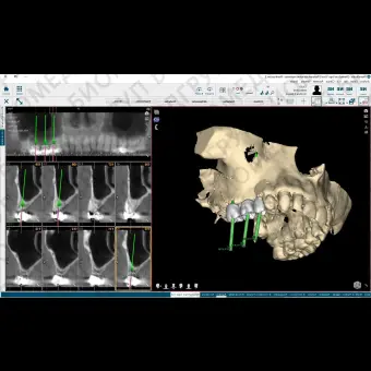 Программное обеспечение для стоматологической имплантологии NemoScan