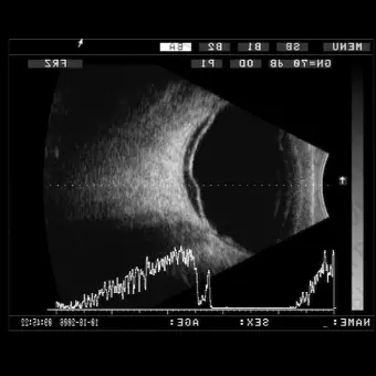 Офтальмологический эхограф ODM2200