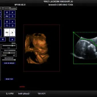 UltraSonix SonixTablet Аппарат УЗИ