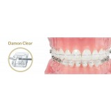 Брекет ортодонтический, модель Damon Clear (клык в.ч. прав. с крючком) 497-7480