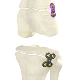 Костная пластина для остеотомии большеберцовая кость WishFIX™